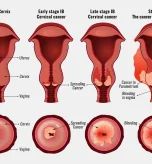 cervical-cancer